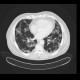 Amiodarone lung, toxic pneumonitis: CT - Computed tomography